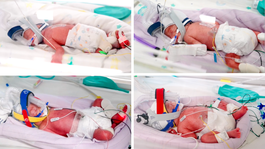 rare-identical-quadruplets-born-in-australia